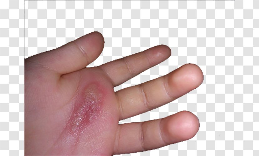 Hand Nail Thumb - Scalding - Burned Hands Portrait Transparent PNG