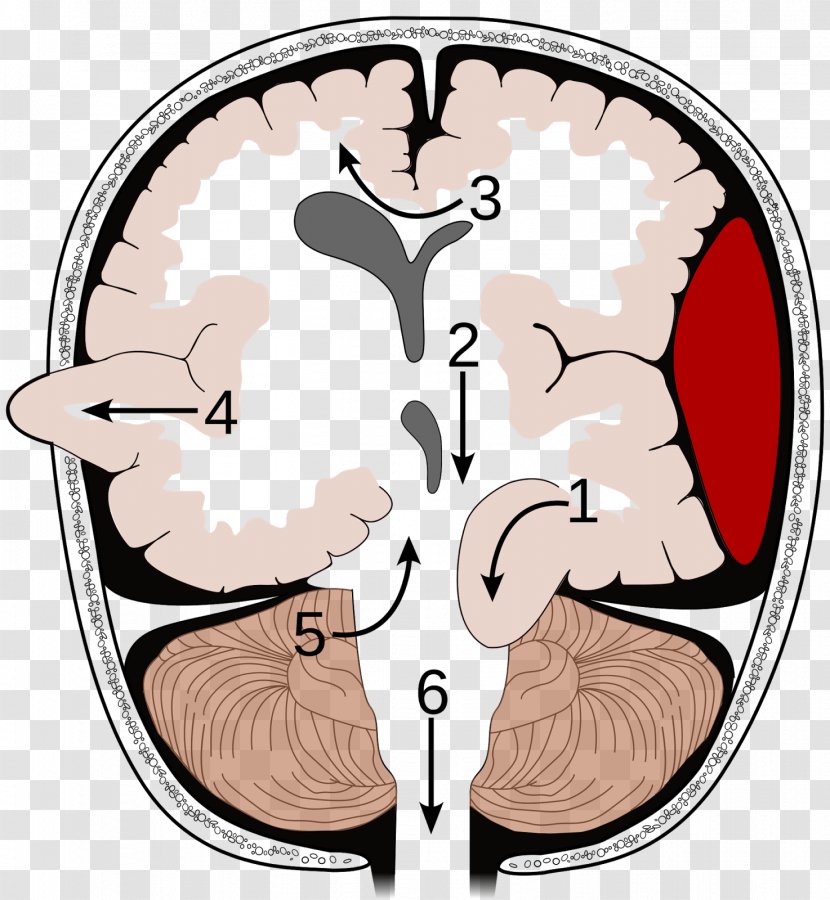 Brain Herniation Intracranial Pressure Tumor Uncus - Flower Transparent PNG