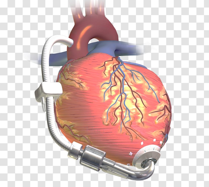 Ventricular Assist Device Heart Transplantation Artificial Hardware Pumps - Cartoon Transparent PNG