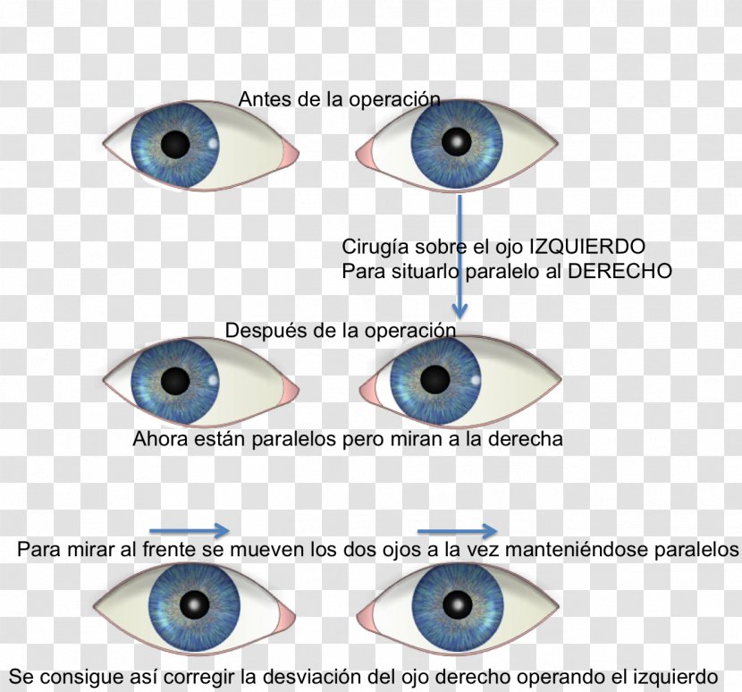 Eye Strabismus Esotropia Ophthalmology Surgery - Frame Transparent PNG
