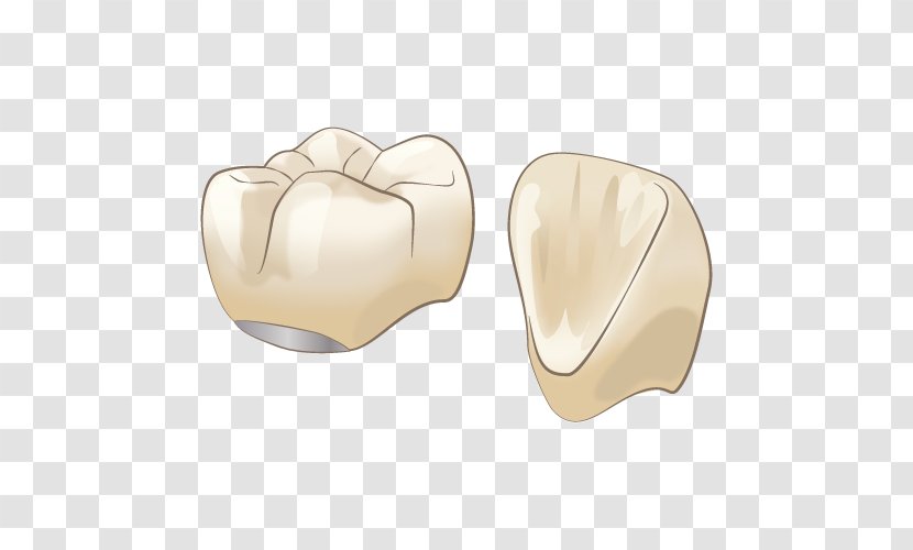 審美歯科 Dentist Therapy Crown - Dental Implant Transparent PNG