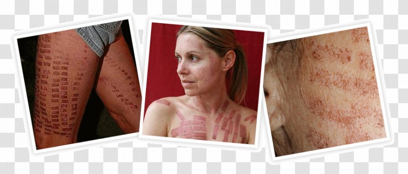 Laser Hair Removal Video Tattoo - Wood - Peel Burns Transparent PNG