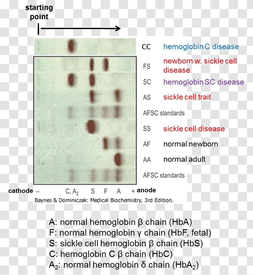 Sickle Cell Disease Hemoglobin C Hemoglobinopathy Electrophoresis - Document Transparent PNG