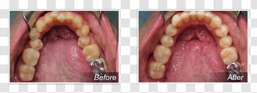 Dr. Michael E. Huguet, DDS Tooth Cosmetic Dentistry Clear Aligners - Tree - Gastroesophageal Reflux Disease Transparent PNG