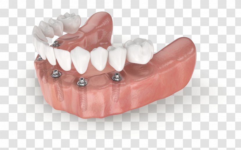 Tooth All-on-4 Dental Implant Dentistry Edentulism Transparent PNG