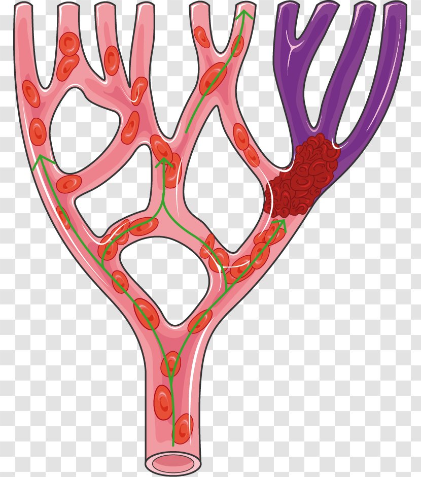 Servier Medical Flickr - Antler - Vascular Bypass Transparent PNG