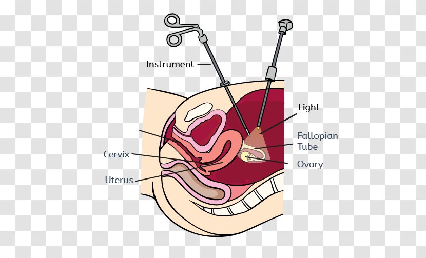 Uterine Fibroid Laparoscopy Myomectomy Endometriosis Laparotomy - Flower - Infertility Transparent PNG
