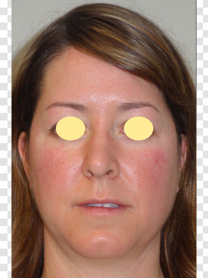 Eyebrow Cheek Chin Forehead Eyelash - Head - Buccal Fat Removal Transparent PNG