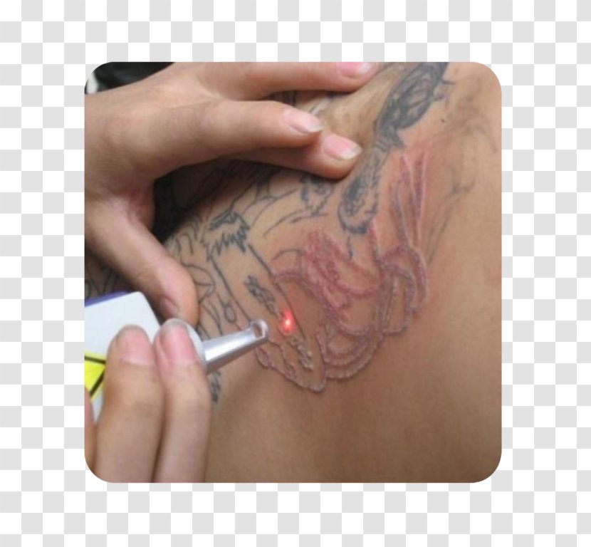 Nail Ojas Aesthetic Tattoo Removal Abziehtattoo Surgery - Watercolor Transparent PNG
