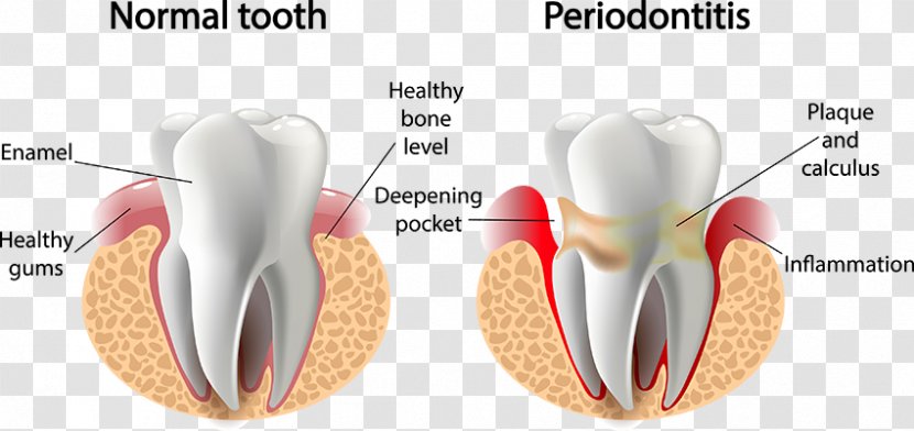 Periodontal Disease Gums Periodontology Dentistry - Watercolor - Health Transparent PNG