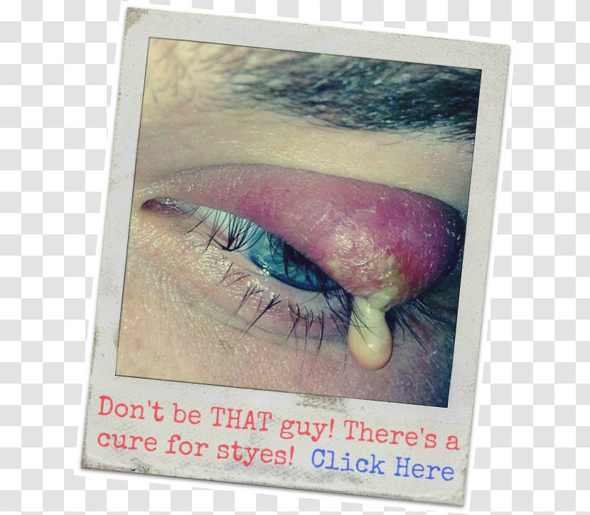 Stye Eyelid Chalazion Warm Compress - Pharmaceutical Drug - Eye Transparent PNG