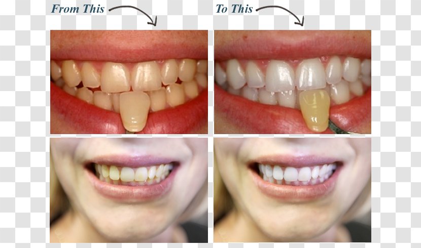 Tooth Whitening Dentistry Human - Oral Hygiene - Dentist Transparent PNG