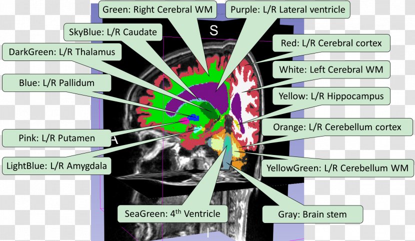 Image Segmentation Graphic Design Brain Implementation - Soft Tissue - Chinese Bian Lian Transparent PNG