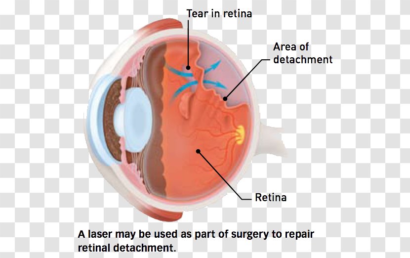 Posterior Vitreous Detachment Retinal Body Floater - Watercolor - Laser Surgery Transparent PNG