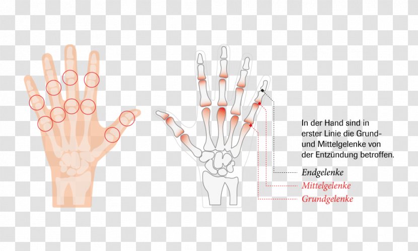 Joint Hand Rheumatoid Arthritis Rheumatism - Heart Transparent PNG