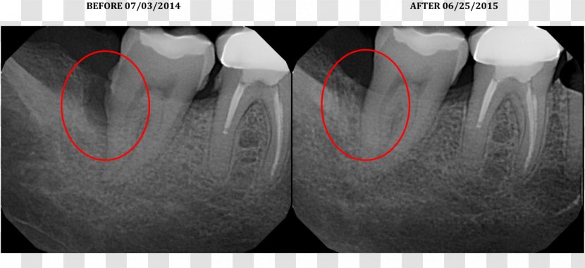 Laser-assisted New Attachment Procedure Surgery Periodontology X-ray - Laser - Gum Disease Transparent PNG