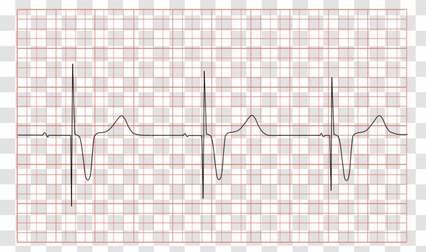 Artificial Cardiac Pacemaker Electrocardiography Syndrome Multifocal Atrial Tachycardia Medicine - Silhouette - Ecg Transparent PNG