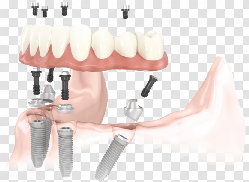 All-on-4 Dental Implant Dentistry - Jaw - Bridge Transparent PNG