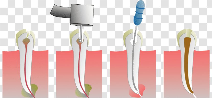 Root Canal Endodontic Therapy Dentistry Medical Procedure - Joint - Human Tooth Transparent PNG