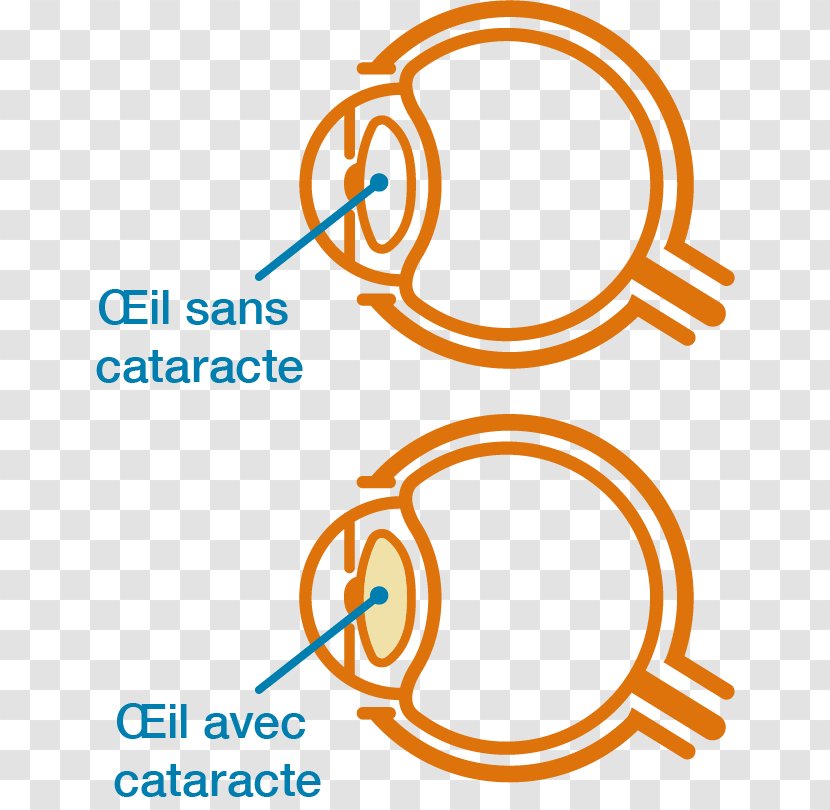 Cataract Vector Graphics Clip Art Stock Illustration - Text - Eye Diagram Transparent PNG