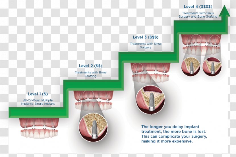 Dental Implant Dentistry Insurance Bridge - Brand Transparent PNG