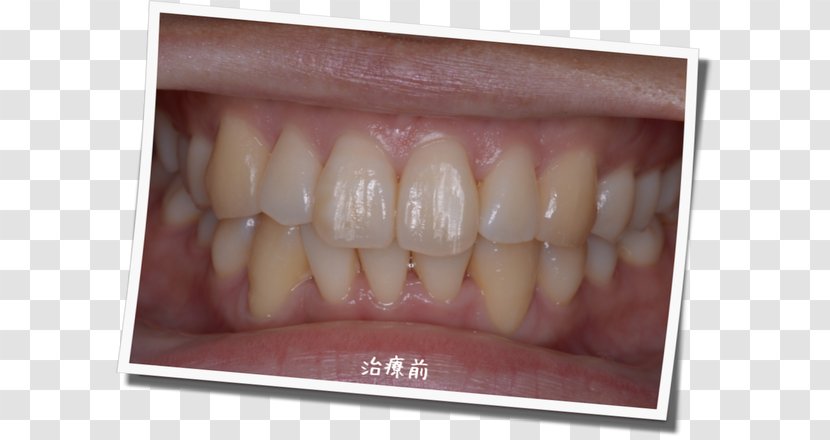 Tooth Whitening 審美歯科 Dentist Gums - Dentition - Dental Postcard Transparent PNG