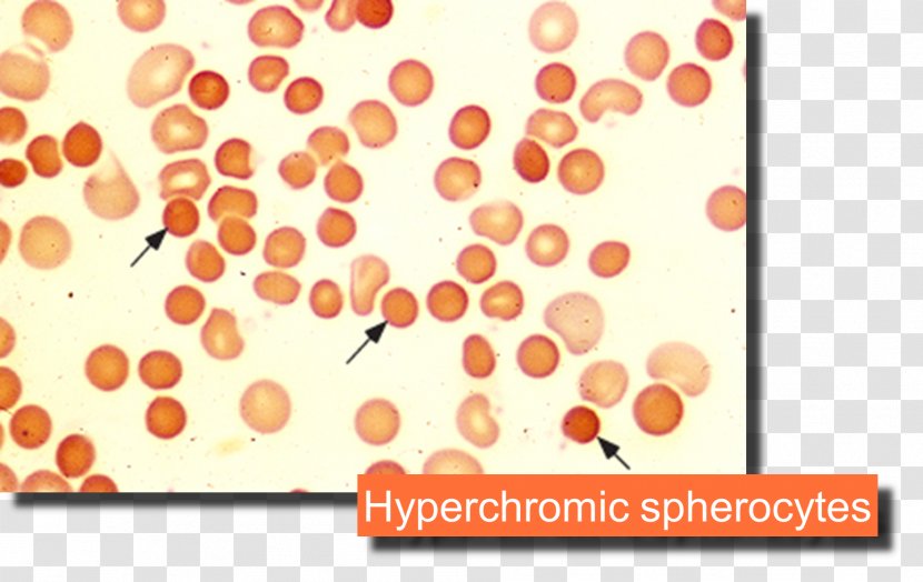 Microangiopathic Hemolytic Anemia Hemolysis Blood - Symptom Transparent PNG