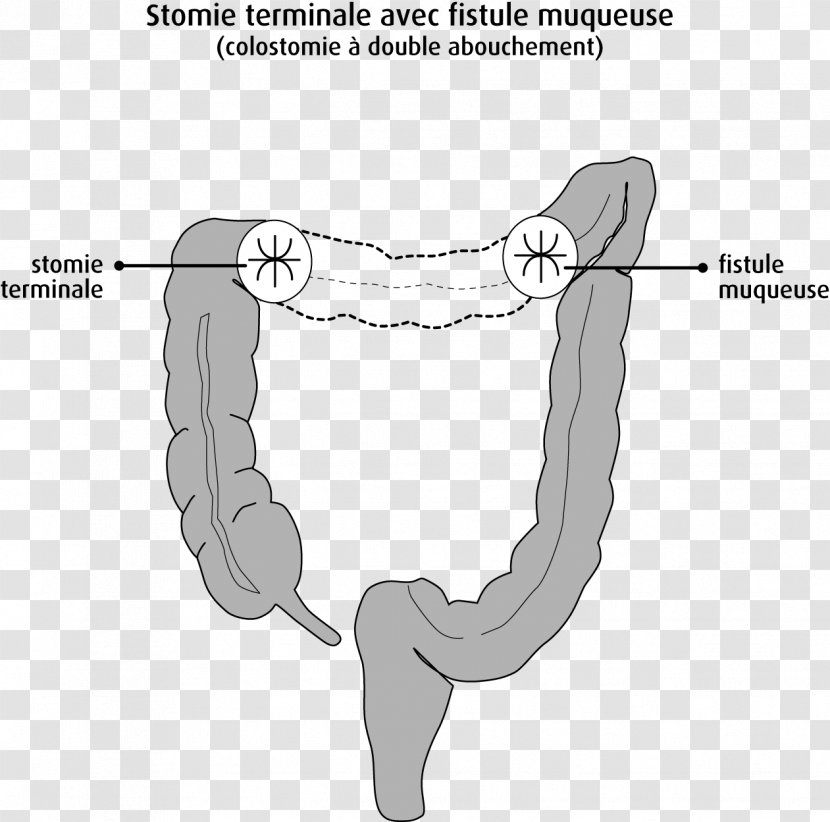 Large Intestine Ileostomy Colostomy Rectum Colorectal Cancer - Tree - Day To End Obstetric Fistula Transparent PNG