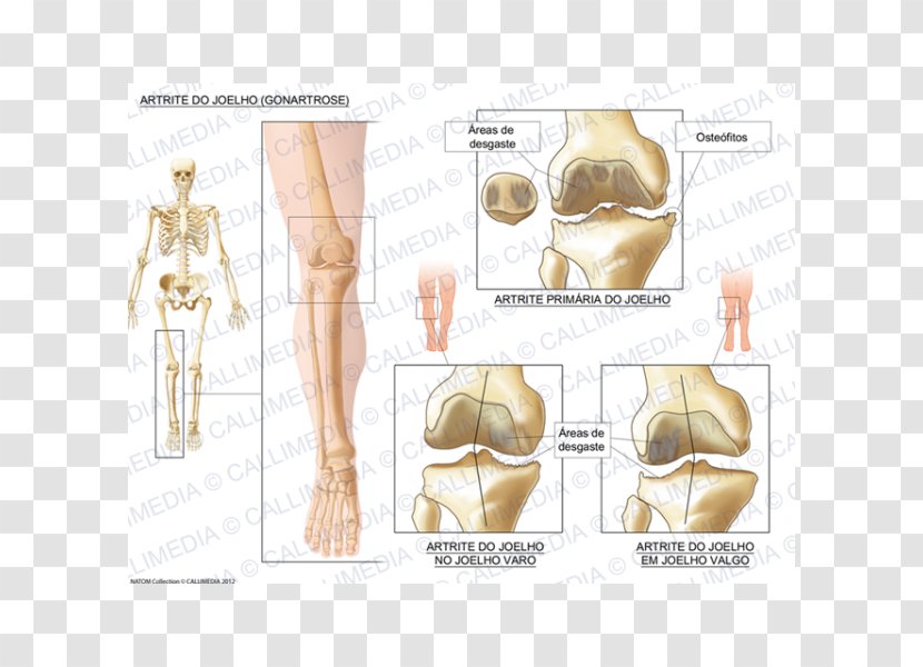 Knee Osteoarthritis Arthritis - Watercolor - Ráº¯n 3d Transparent PNG