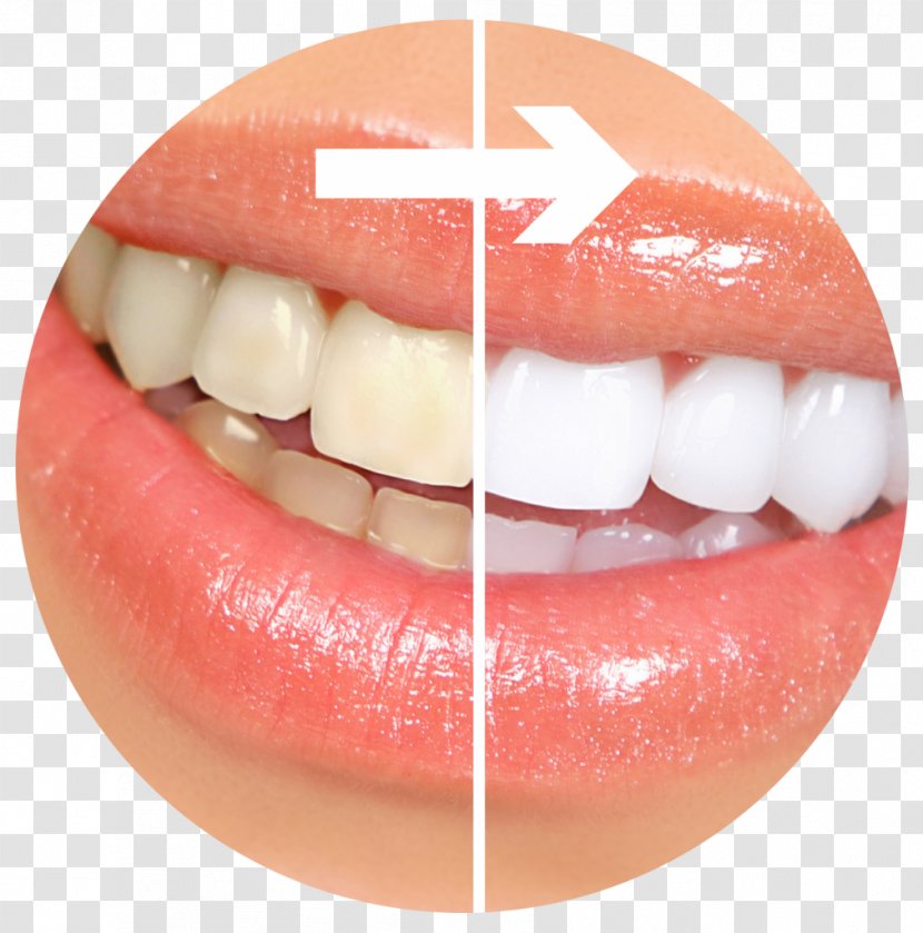Tooth Whitening Cosmetic Dentistry Human - Tongue - Toothpaste Transparent PNG
