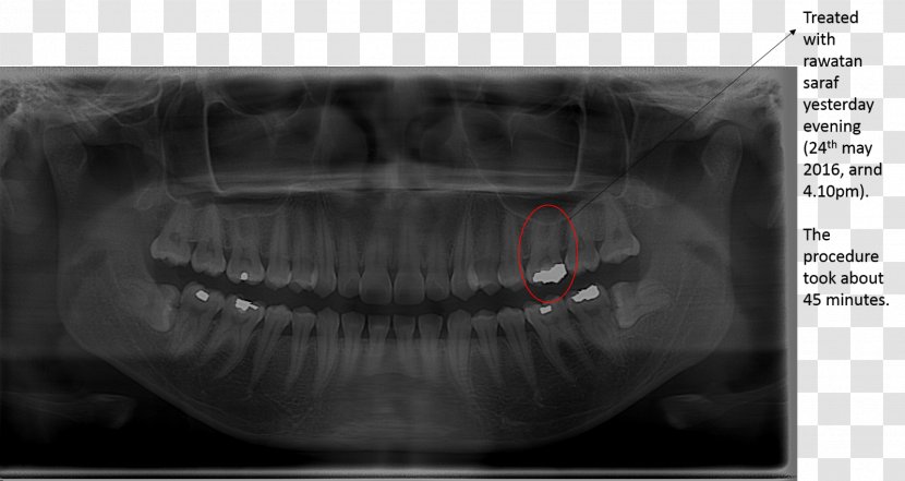 Wisdom Tooth Toothache Root Canal Jaw - Radiology - Cherish Teeth Transparent PNG