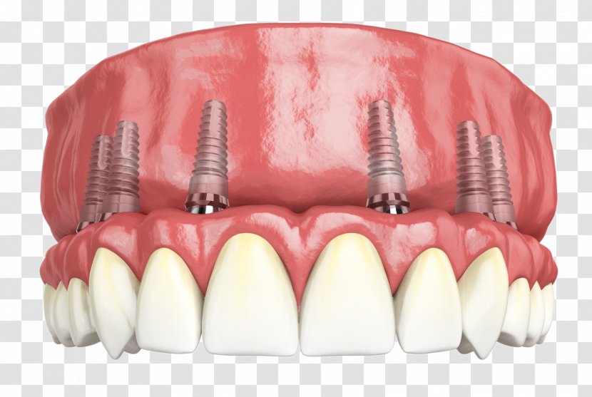 Hybridge Dental Implants Giesy Family And Implant Dentistry - Watercolor - Restoration Transparent PNG