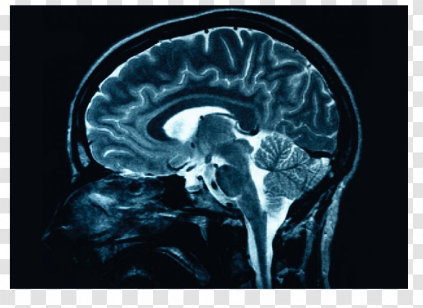 Human Brain X-ray Head Injury Medicine - Cartoon Transparent PNG