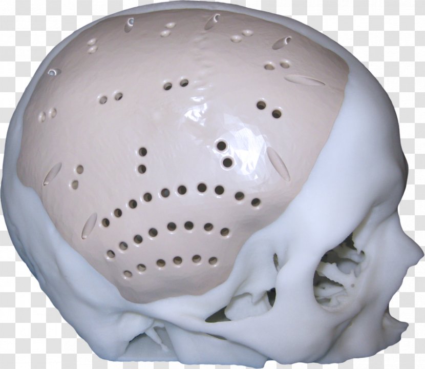 Jaw Implant Skull Cranioplasty Surgery - 3d Printing Transparent PNG