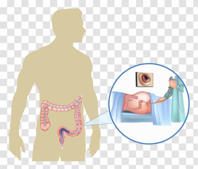 Colonoscopy Gastroenterology Endoscopy Colorectal Cancer Large Intestine - Cartoon - Patient Transparent PNG
