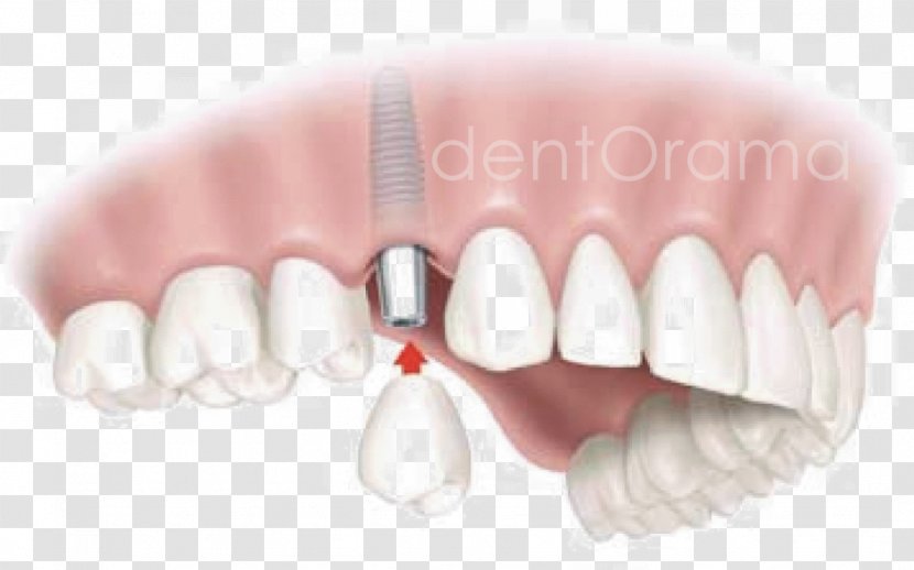 Dental Implant Dentistry Edentulism Tooth - Bridge Transparent PNG