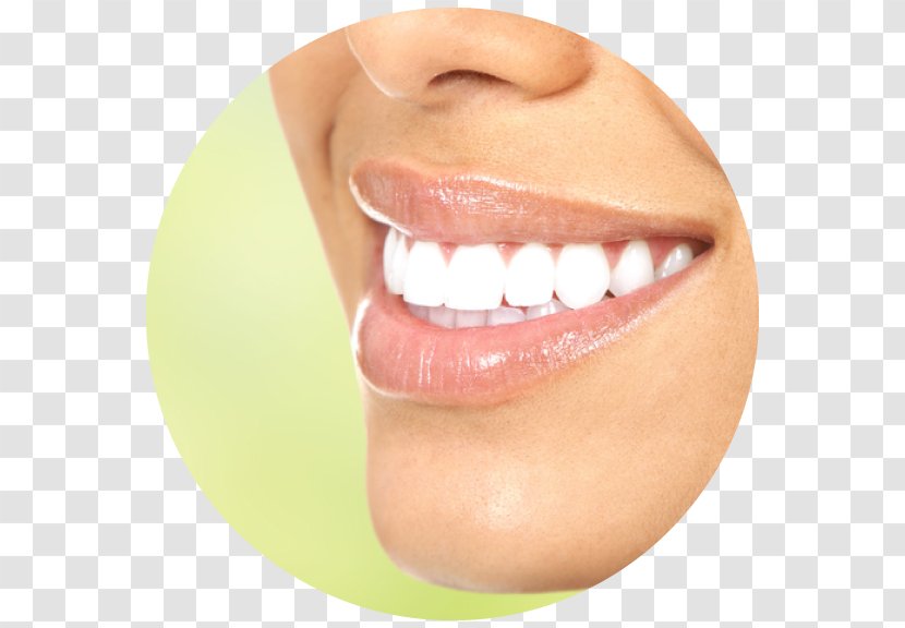 Tooth Whitening Cosmetic Dentistry - Veneers Transparent PNG