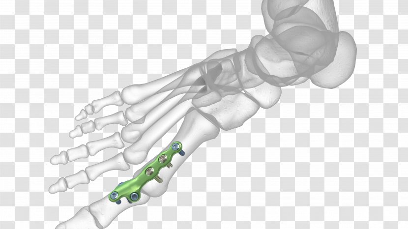 Thumb Metatarsophalangeal Joints Arthrodesis Surgery - Bone Fracture - Plating Transparent PNG