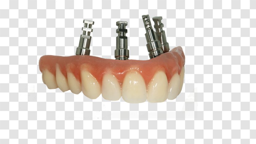 Bridge Tooth Dentures Prosthesis Dentistry - Dental Laboratory Transparent PNG