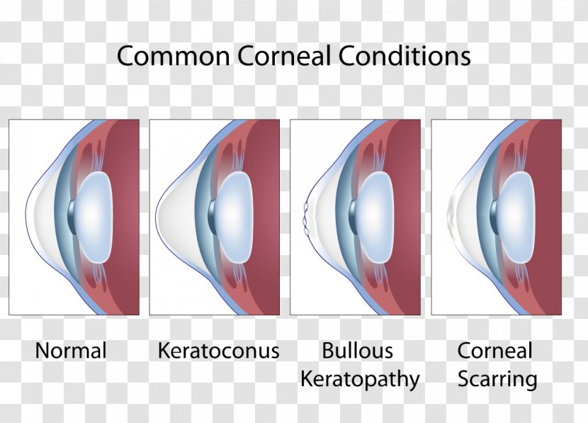 Keratoconus Cornea Symptom Eye Ophthalmology Transparent PNG