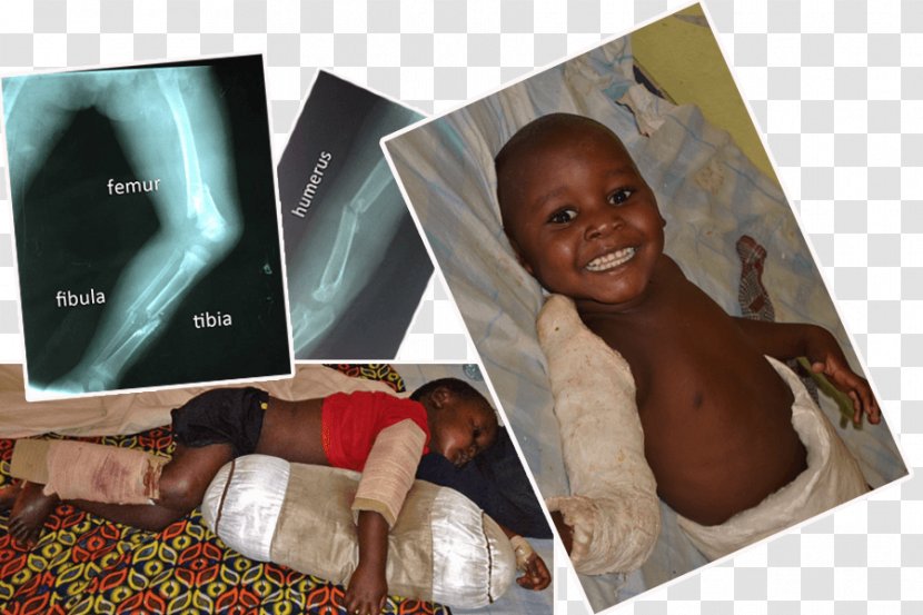 Child Tibia Bone Fracture Femur Transparent PNG
