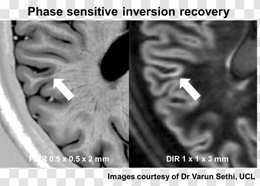 Multiple Sclerosis Magnetic Resonance Imaging Depression Cognitive Disorder Disease - Face - Graymatter Transparent PNG