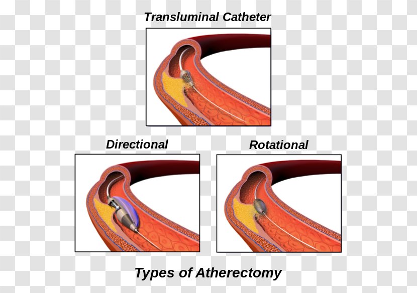 Atherectomy Peripheral Artery Disease Surgery Cleveland Clinic - Catalan Wikipedia - Vascular Bypass Transparent PNG