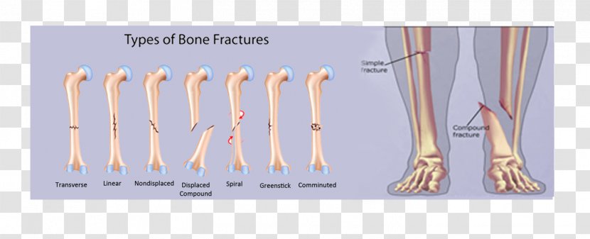 Bone Fracture Comminution Joint Pathologic - Text Transparent PNG