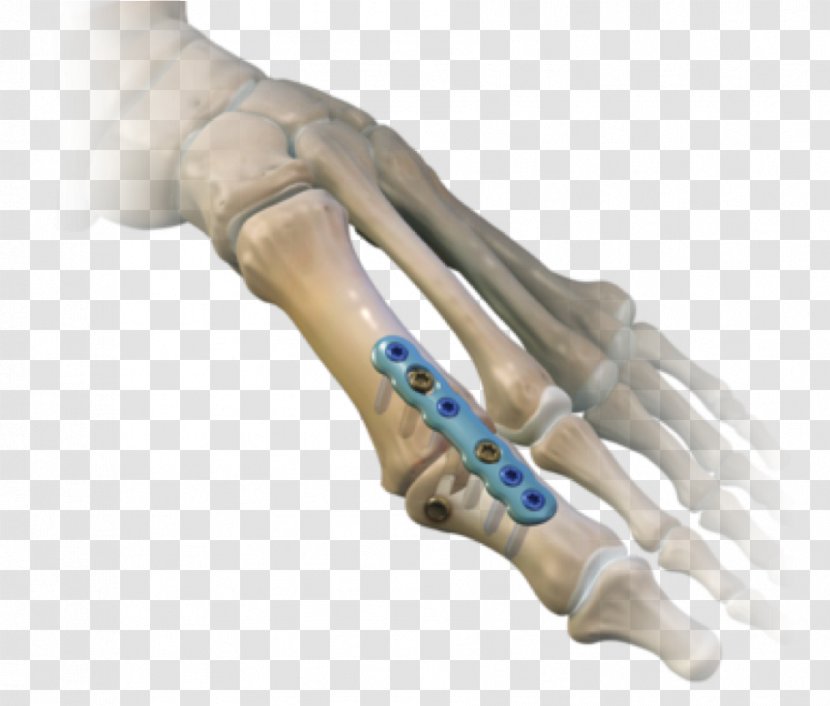 Metatarsophalangeal Joints Arthrodesis Hallux Rigidus Surgery Bunion - Medical Glove Transparent PNG