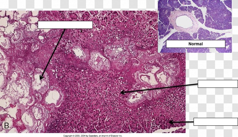 Acute Pancreatitis Histopathology Histology Necrosis Disease - Heart - Microscope Transparent PNG