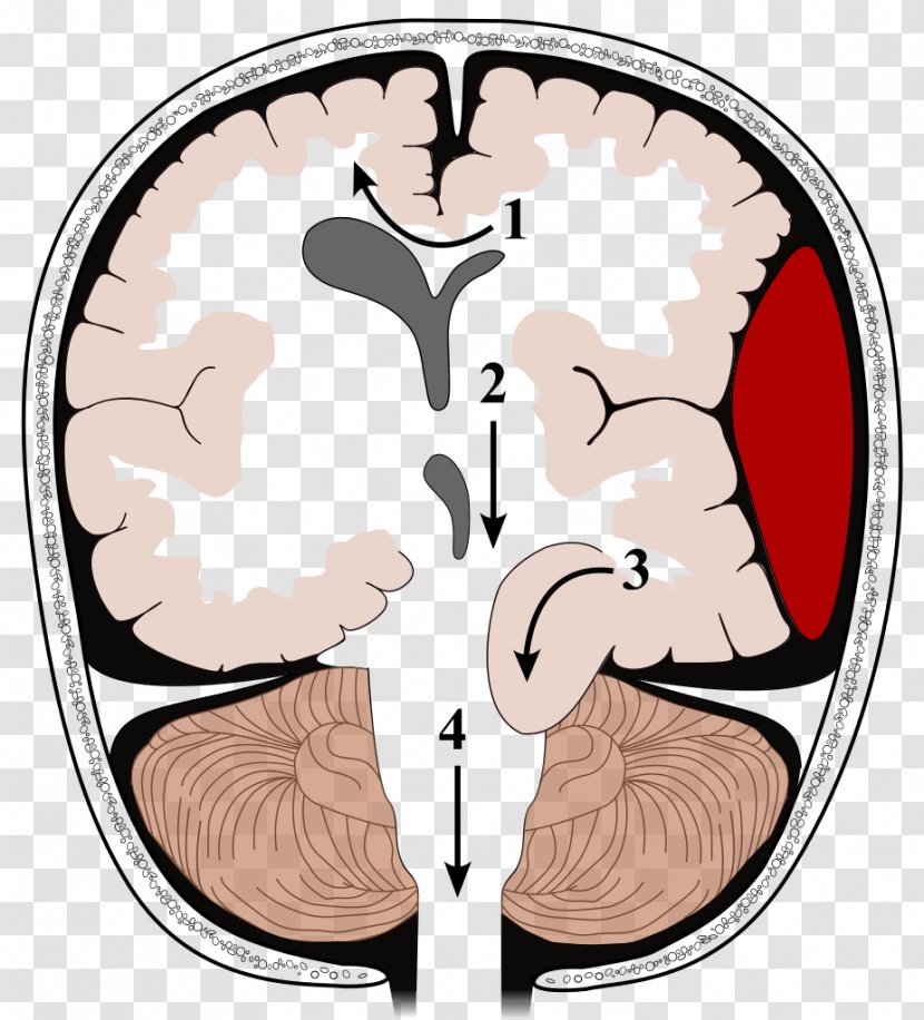 Brain Herniation Intracranial Pressure Traumatic Injury Kernohan's Notch - Silhouette Transparent PNG