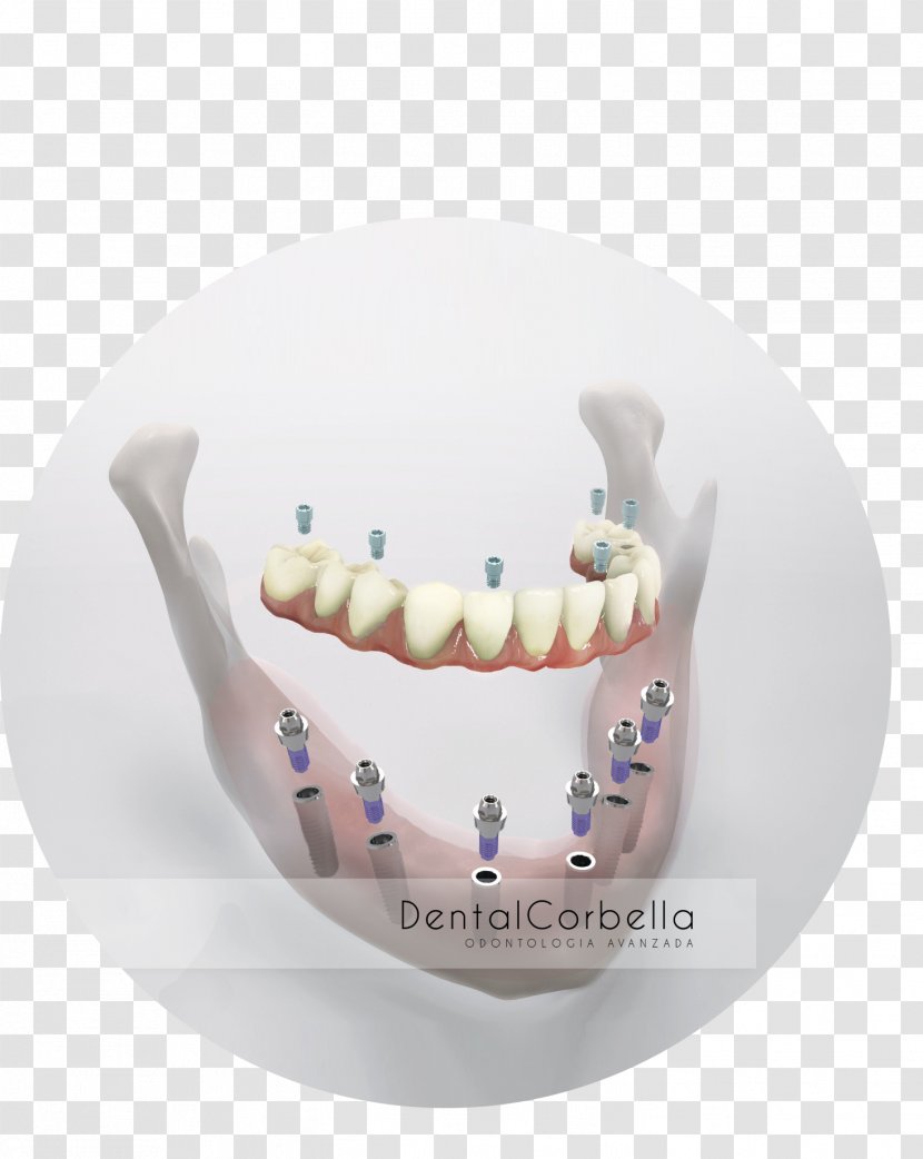 Human Tooth Dental Implant Dentistry Dentures - Zwp Zahnarzt Wirtschaft Praxis - Cirujano Dentista Implantes Transparent PNG