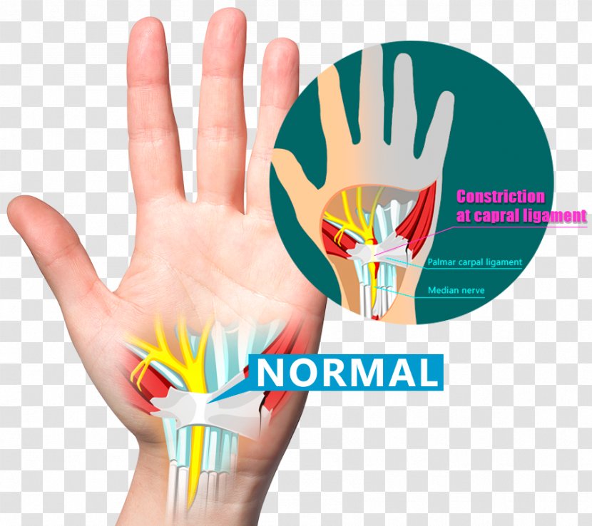 Wrist Pain Carpal Bones Tunnel Syndrome Ligament - Hand Transparent PNG