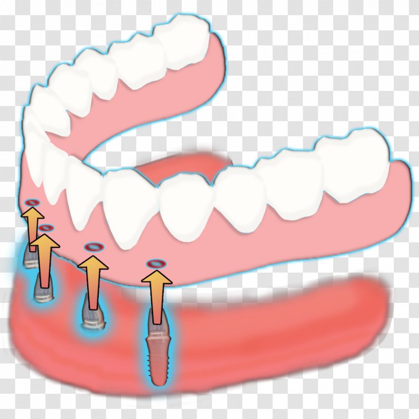Tooth Mini Dental Implants: Principles And Practice Complete Dentures - Watercolor - Rail Transparent PNG